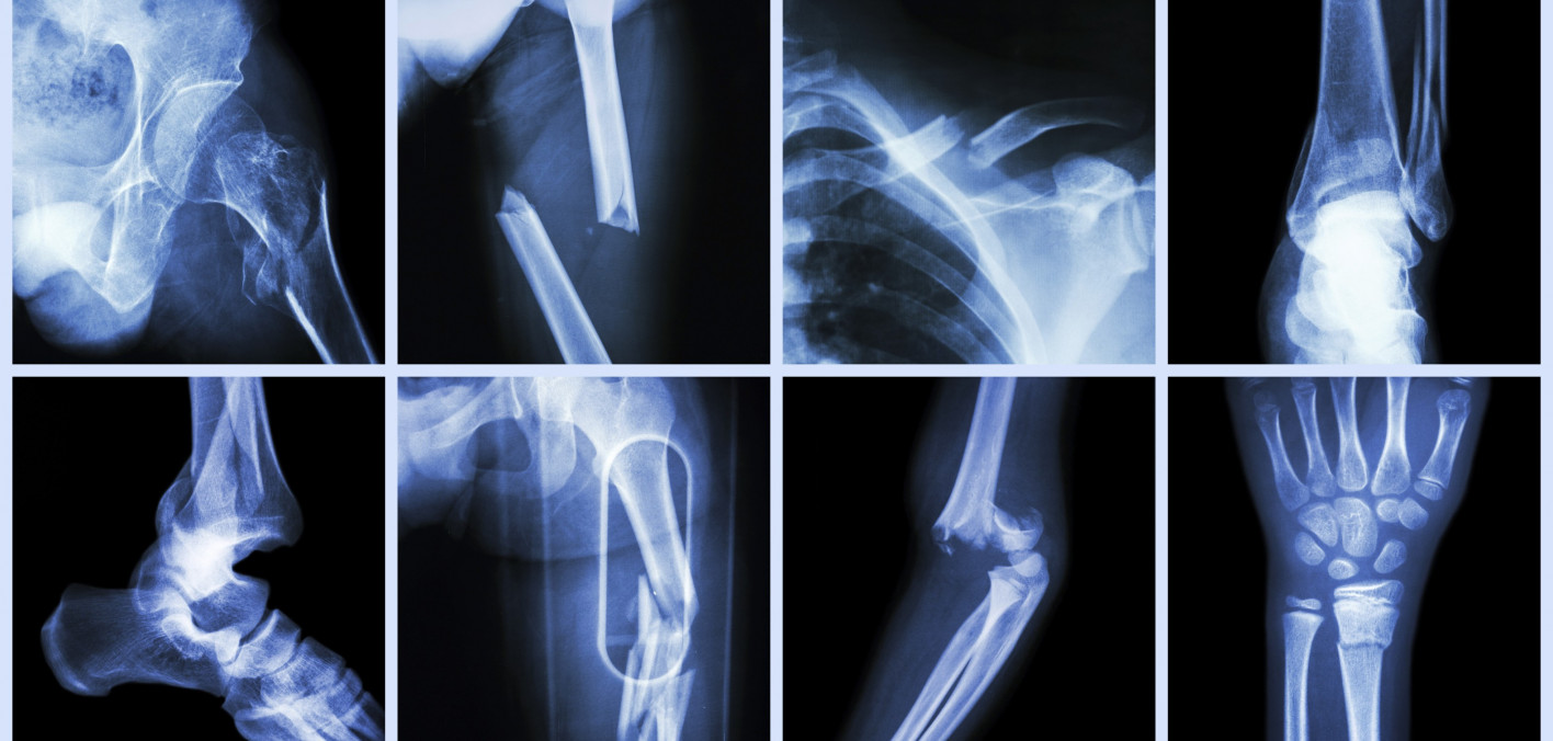 HIV and Bone Loss at Menopause Go Hand in Hand POZ